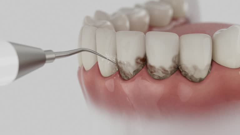 Trusted Wisdom Tooth Removal service in Sea Isle City, NJ - Dentist Open Now
